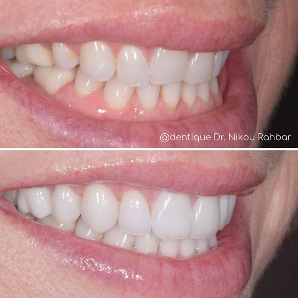 veneers-&-gum-contouring-5