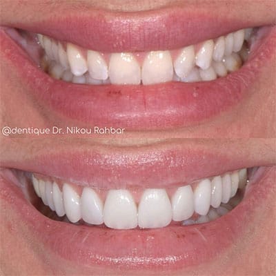 upper-veneers-1