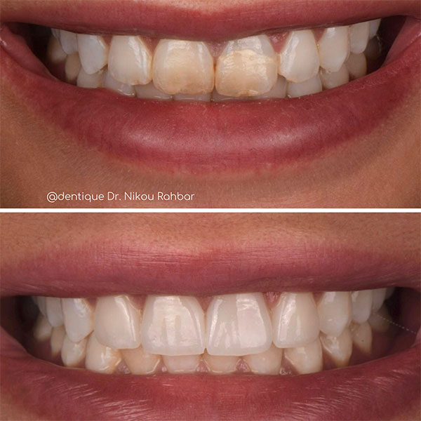 2-crowns-2-veneers-new
