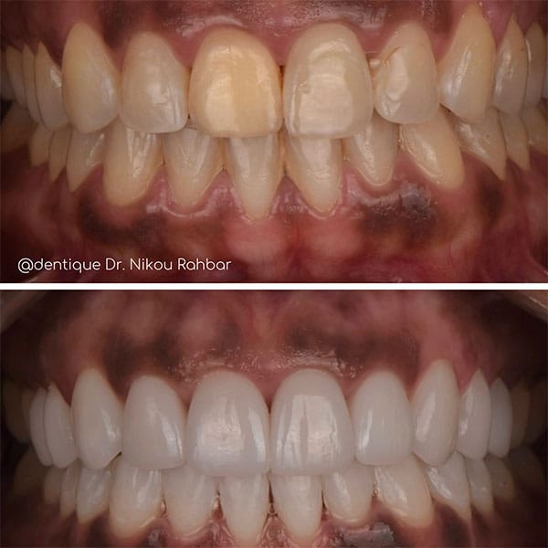 9-veneers