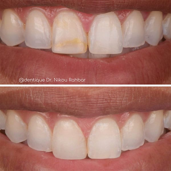 Composite-Bonding-Case