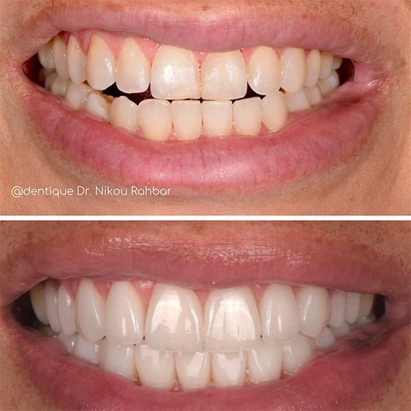 Full-mouth-reconstruction