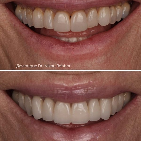 full-smile-makeover