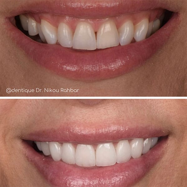 smile-makeover