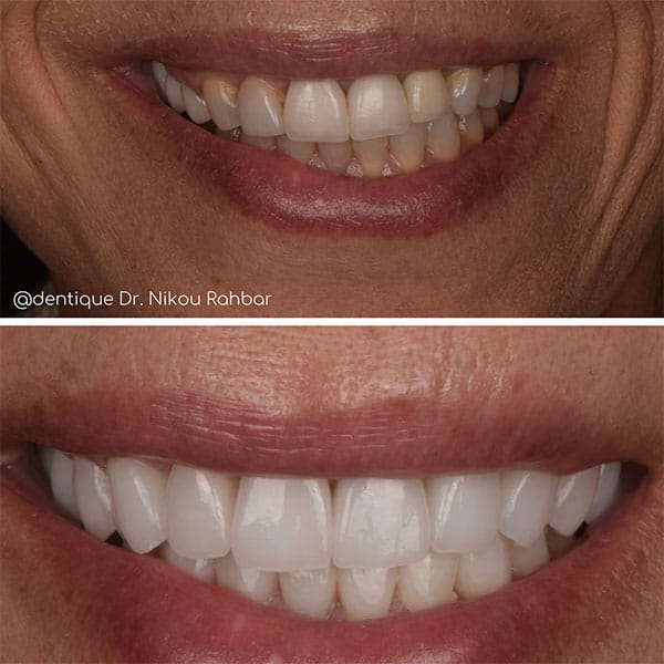 smile-upgrade